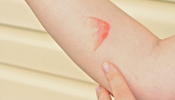 Ожоги: что делать и как лечить